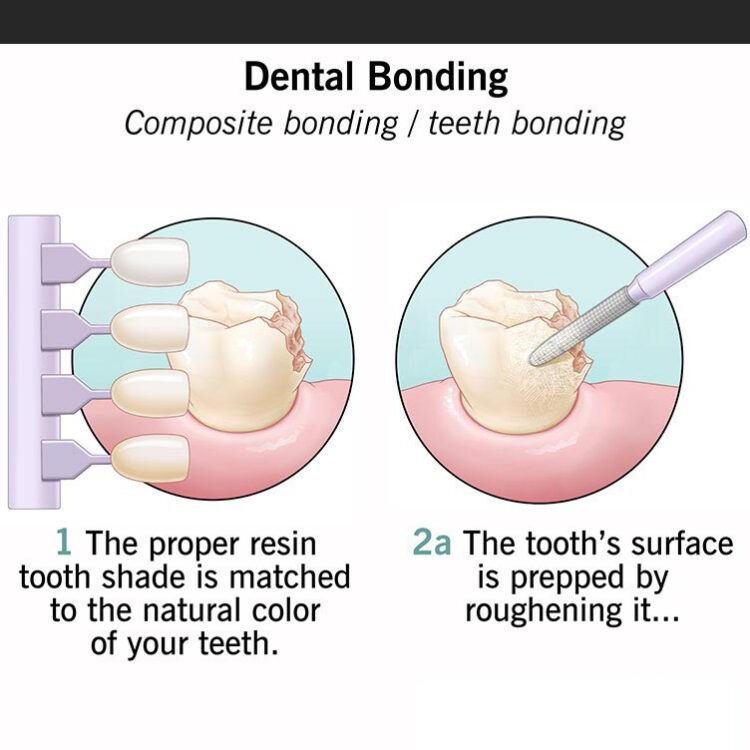 dental-bonding-1