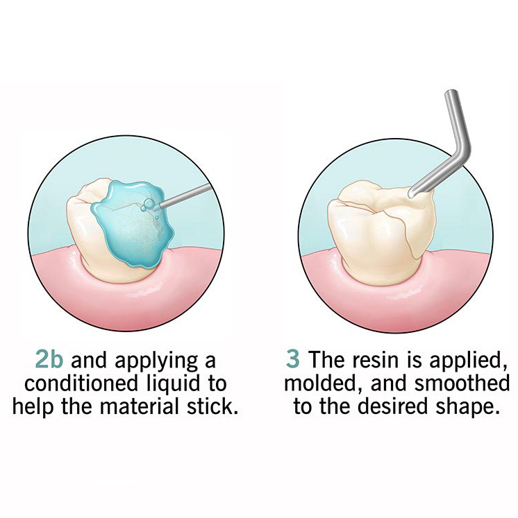 dental-bonding-2