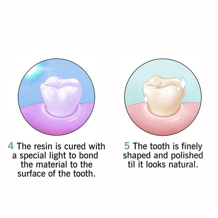 dental-bonding-3